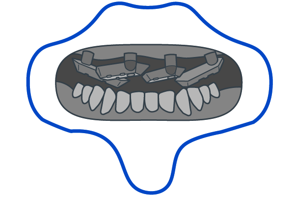 Gauge-Placement-Retractors-Filled.png