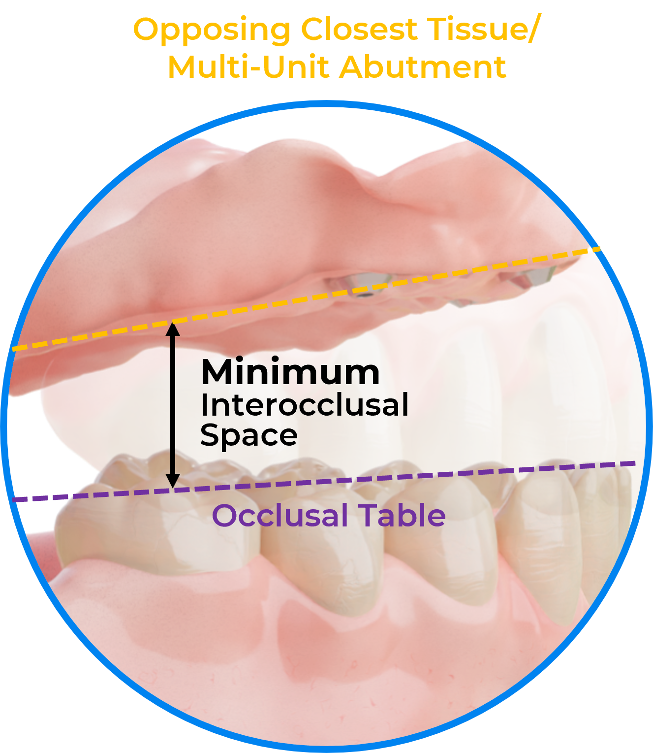 Interocclusal-space-annotated.png