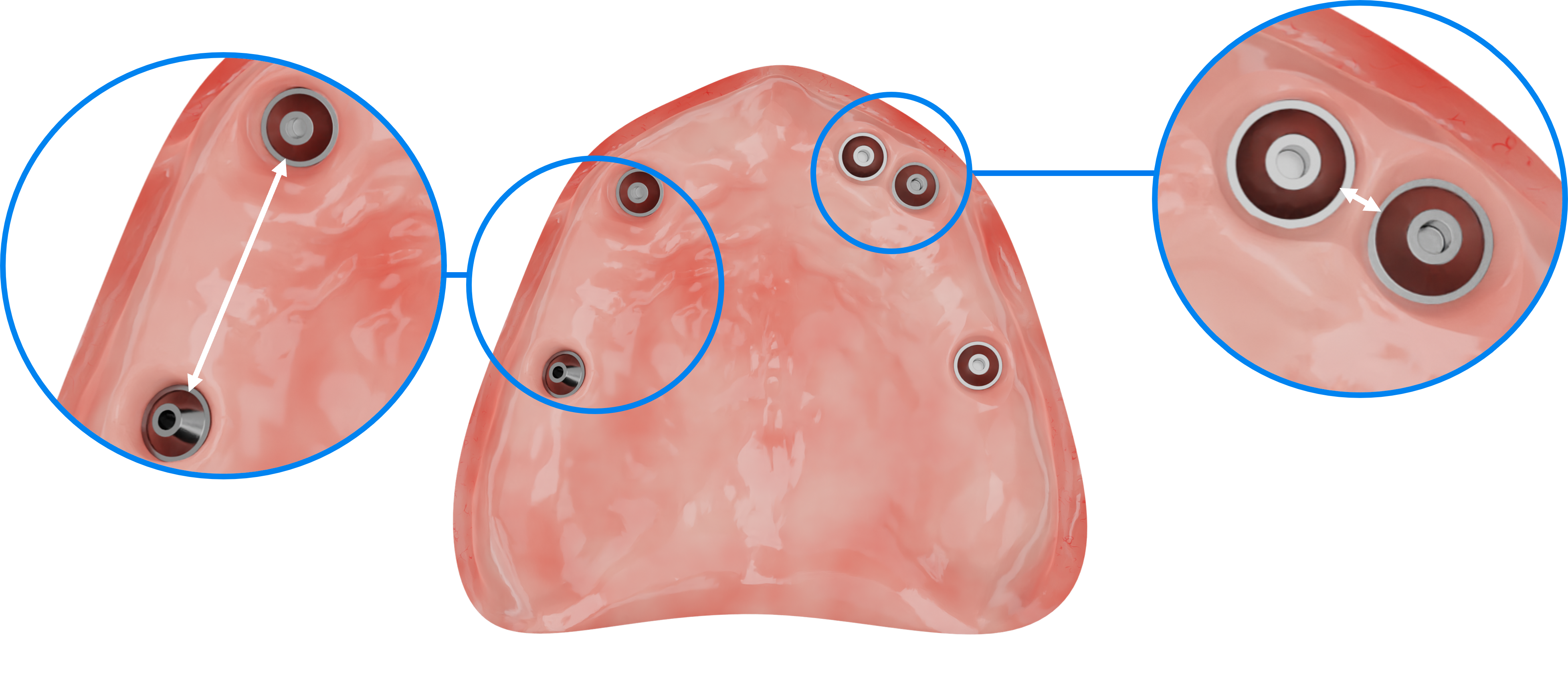 inter-implant-space.png