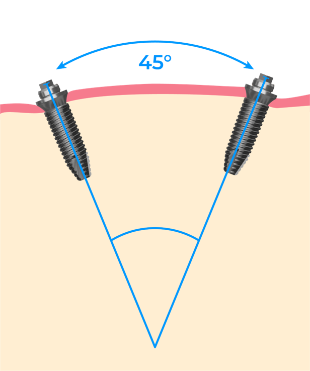 Maximum Divergence - Path of Insertion.png