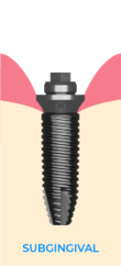 Subgingival-MUA-selection.png