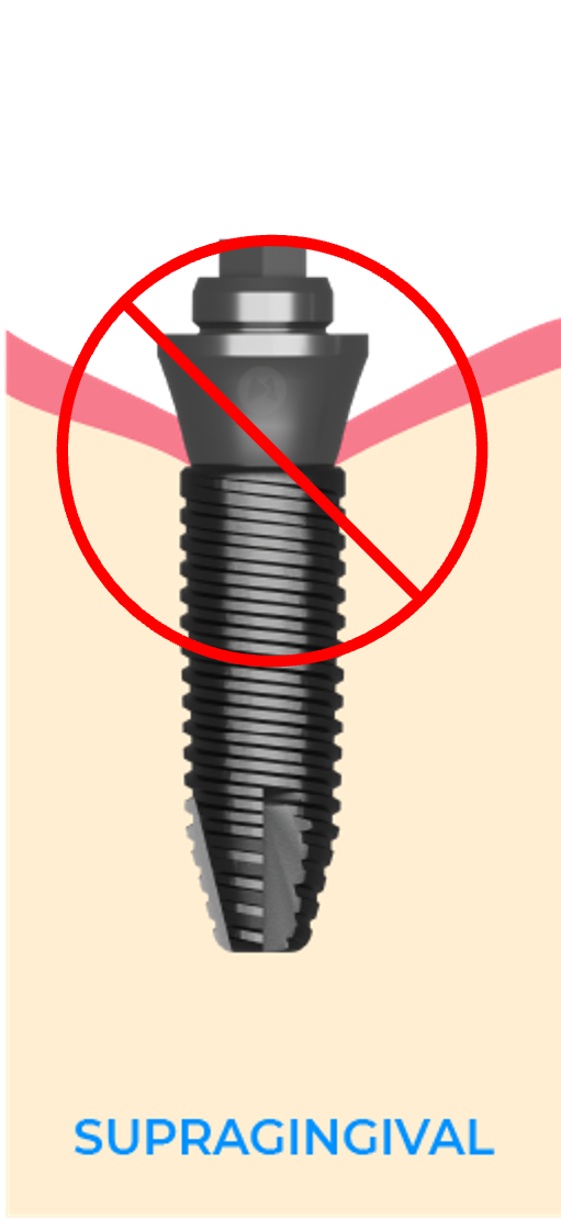 Supragingival-mua-selection.png